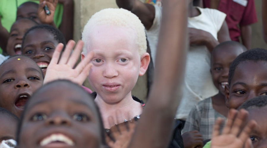 The Killings of Albinos in South Africa with Kuli Roberts